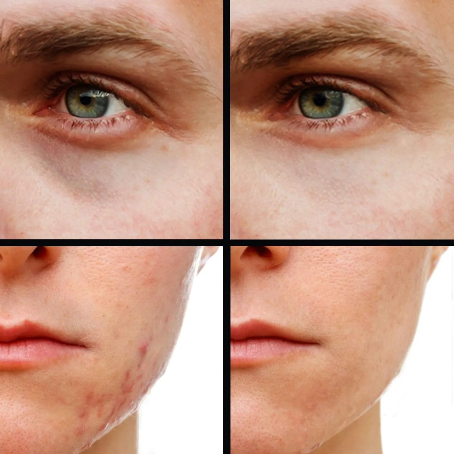 Concealer (Shade 6 of 6) Dark Circle Under Eye Cream Corrector, Multi-Use, Pimples, Scars, Rashes